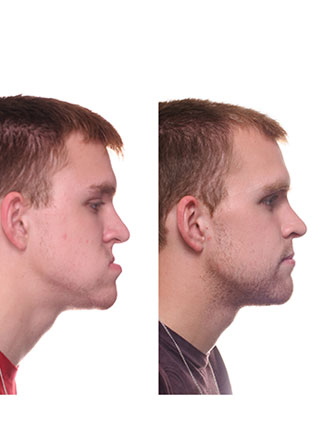 corrective jaw surgery